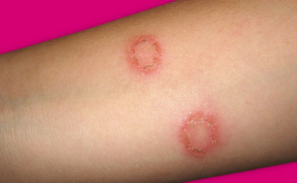 garlic cure ringworm