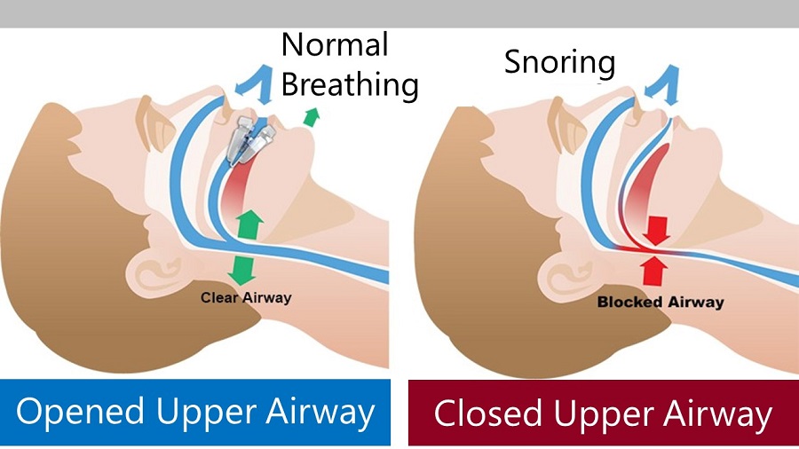 how to stop snoring at night-2